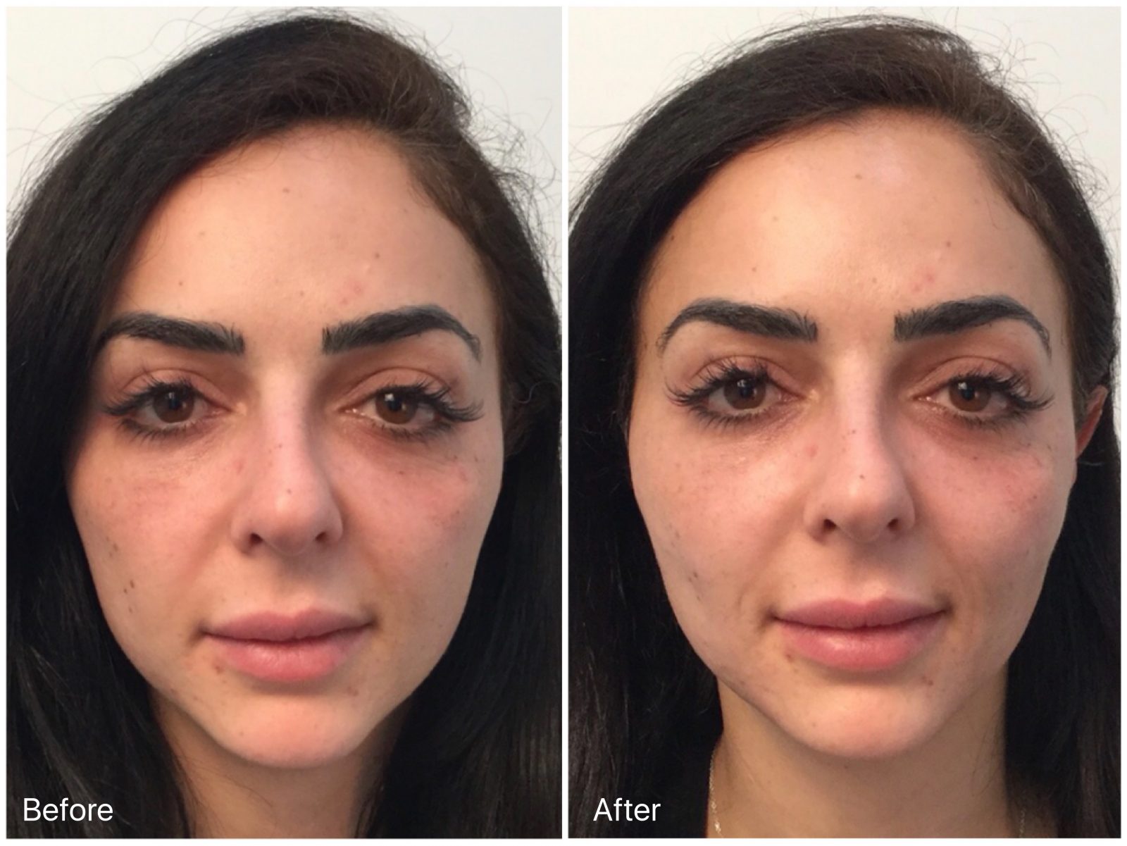 non surgical facelift clinic sydney