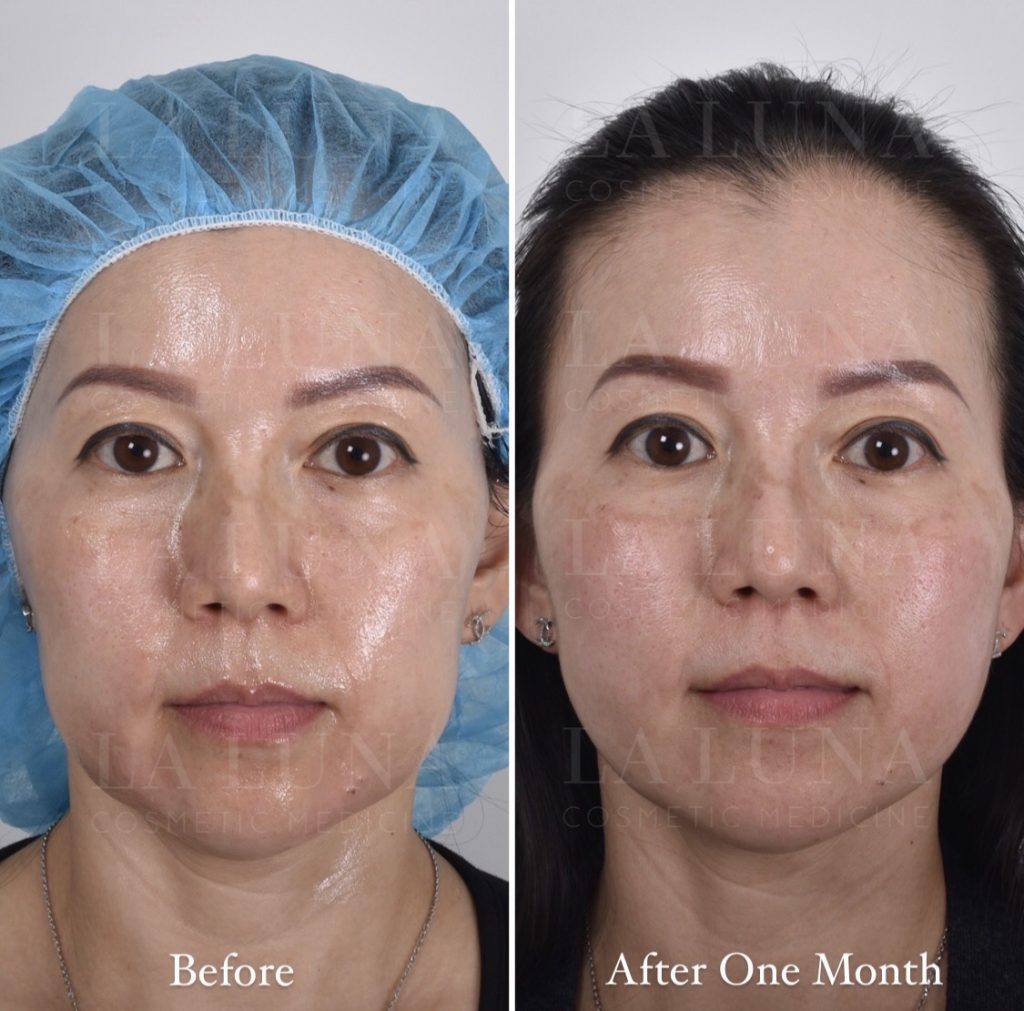 Thread Lift Sydney 1 Cosmetic Doctors Face Neck & Cheek Lift