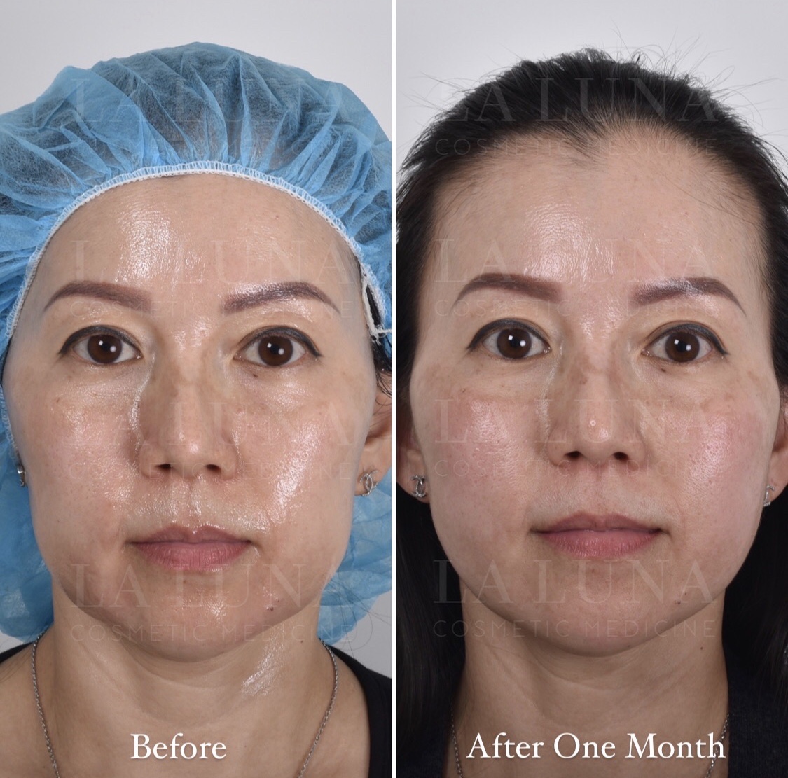 Nonsurgical facelift clinic