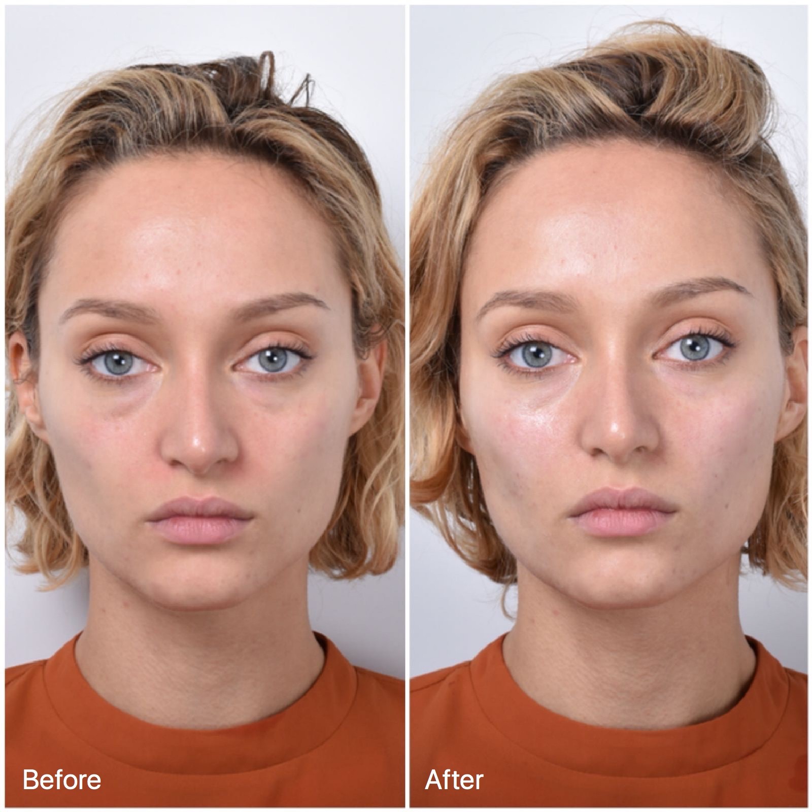 face lift cheek non surgical thread treatments facial enhance sydney neck cosmetic assess individualise understand each unique different person