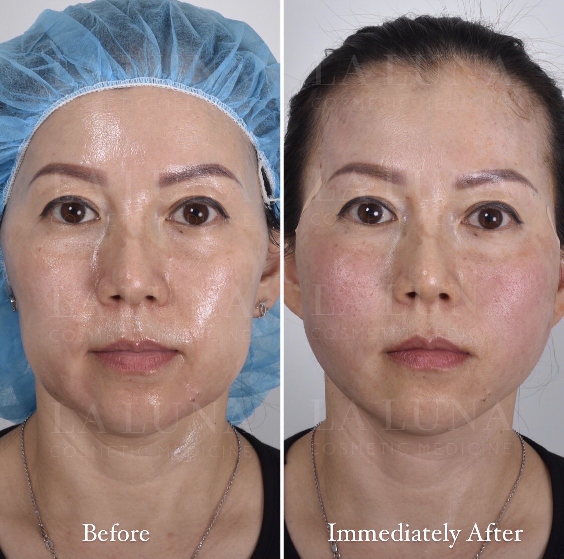 Thread Lift Sydney - #1 Cosmetic Doctors Face - Neck & Cheek Lift ...