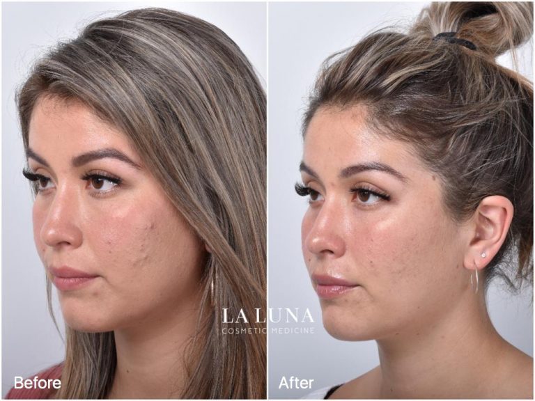Thread Lift Sydney 1 Cosmetic Doctors Face Neck & Cheek Lift