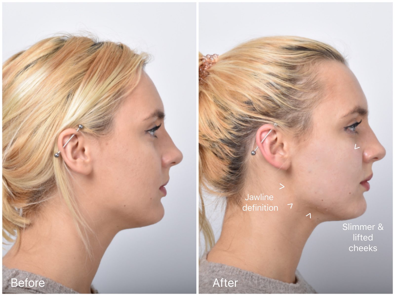 non surgical facelift sydney