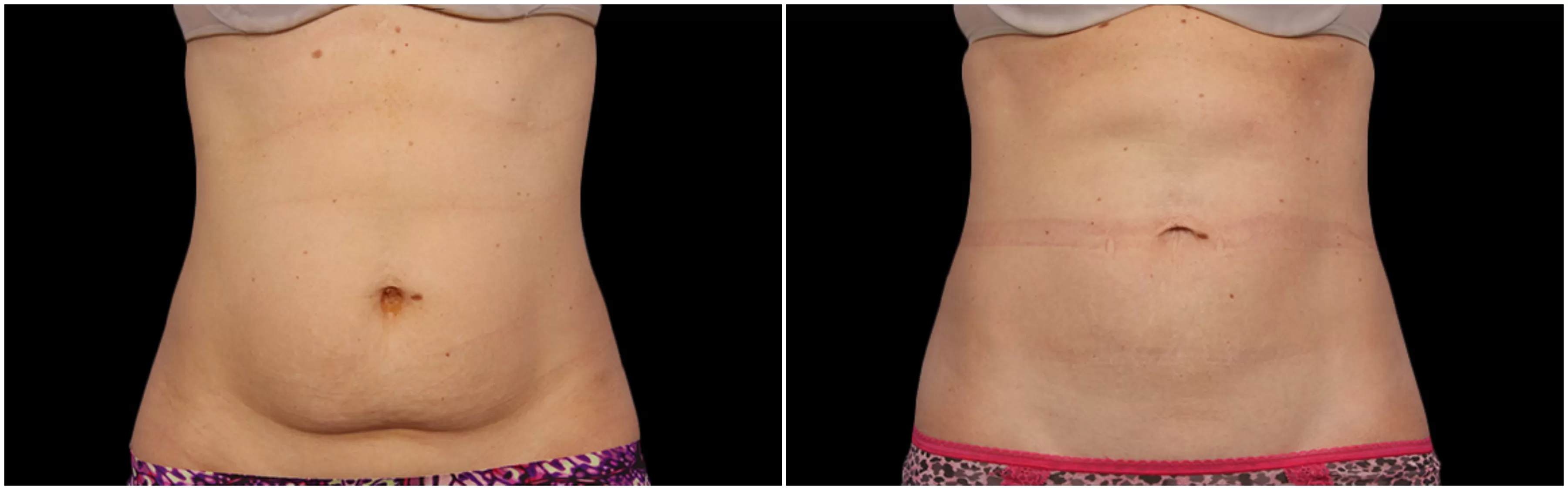 CoolSculpting Fat Freezing Abdomen