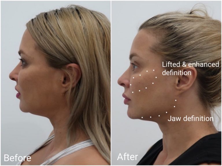 Thread Lift Sydney - #1 Cosmetic Doctors Face - Neck & Cheek Lift ...