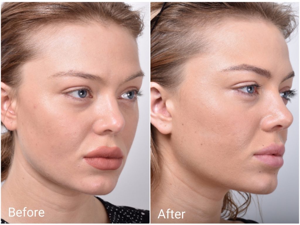 Thread Lift Sydney 1 Cosmetic Doctors Face Neck & Cheek Lift