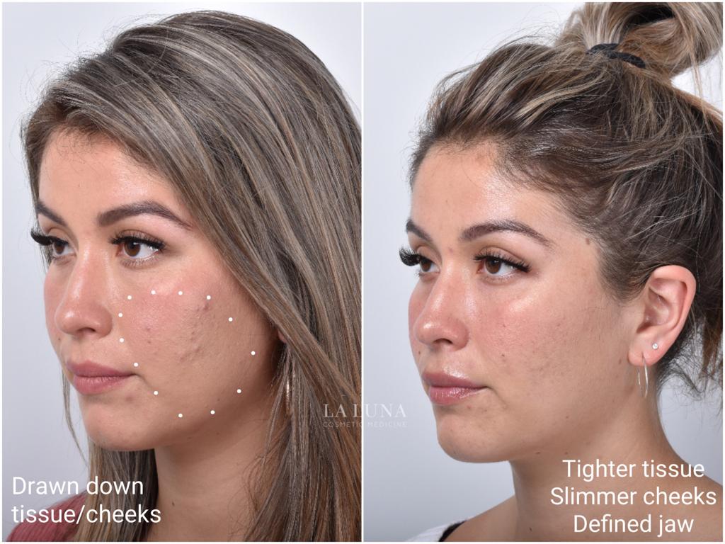 Thread Lift Sydney - #1 Cosmetic Doctors Face - Neck & Cheek Lift ...