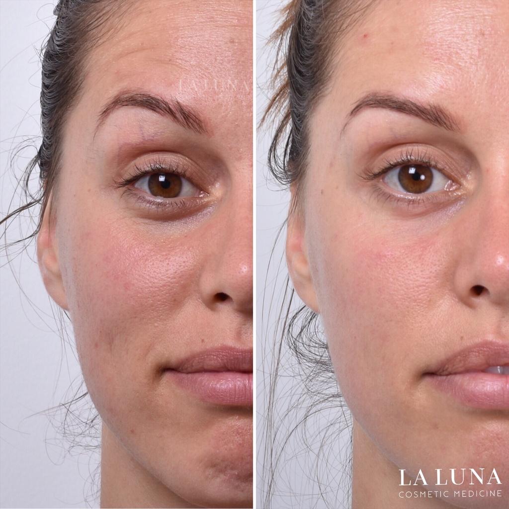 Fine Lines Anti Aging Treatments La Luna Cosmetic Medicine