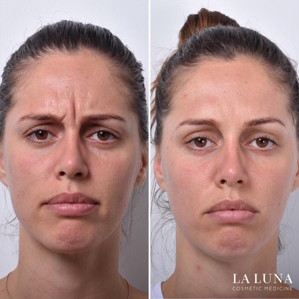 before and after frown line removal