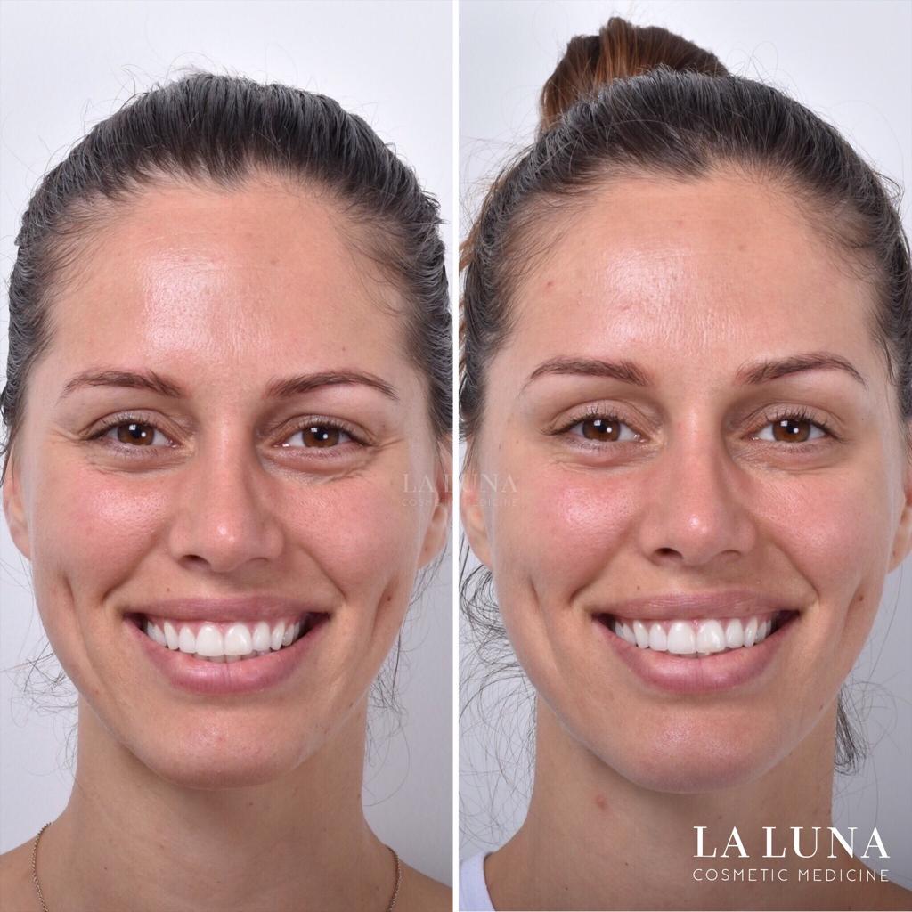 Anti Wrinkle Injections Sydney La Luna Cosmetic Anti Aging Treatments