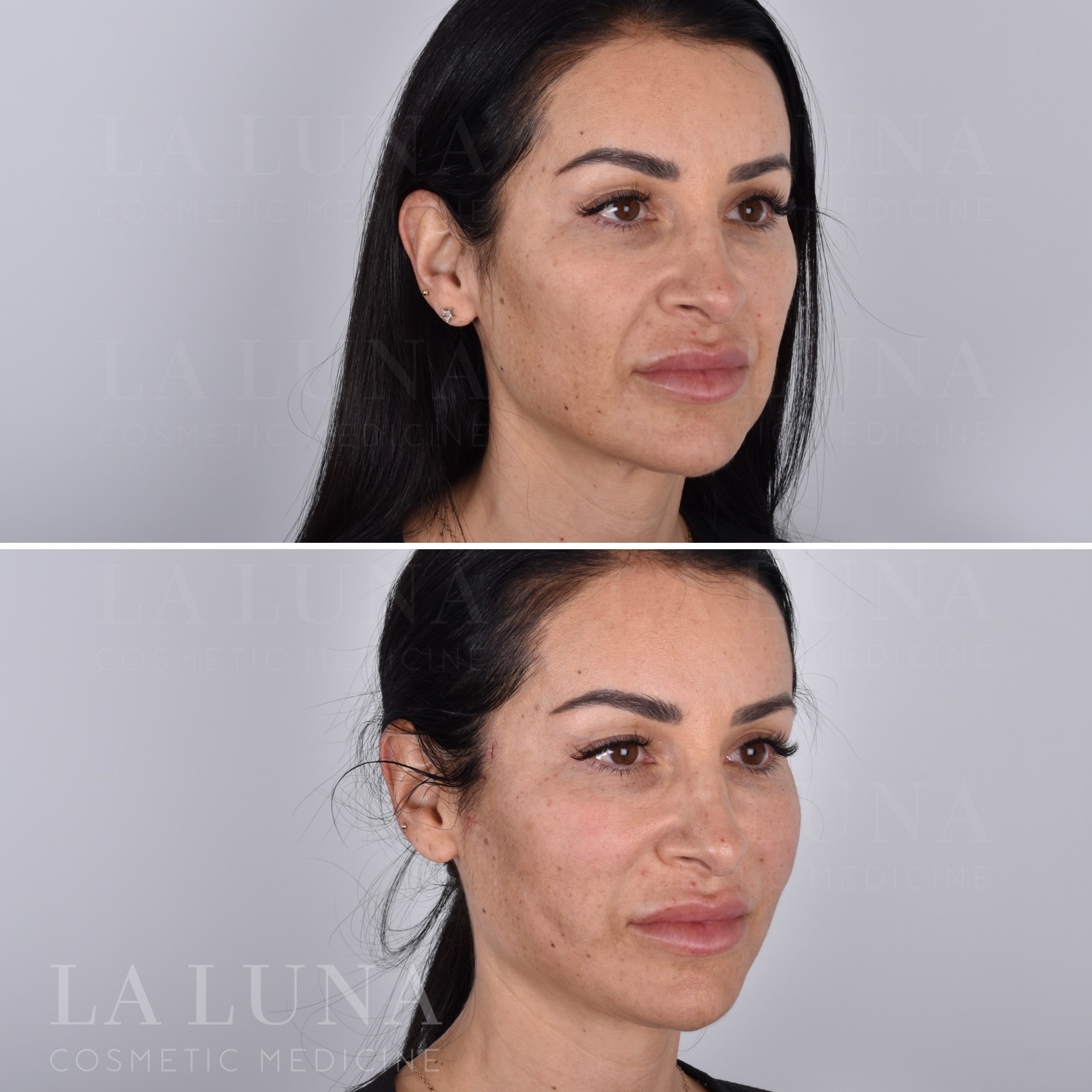 Thread Lift Sydney - Thread Face Lift - Fox Eye - Cheek - Neck