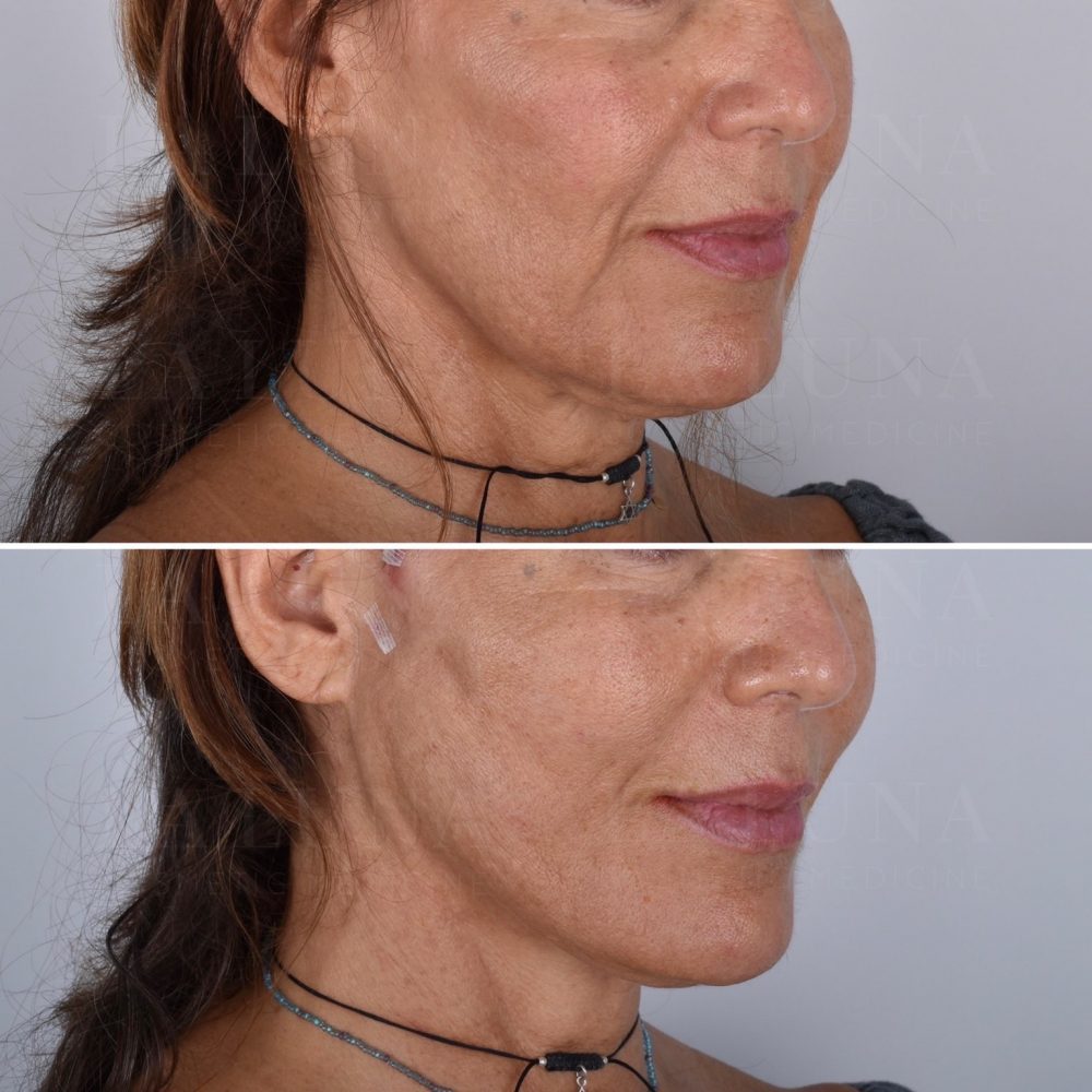 Thread Lift Sydney Thread Face Lift Fox Eye Cheek Neck Jowl Lift