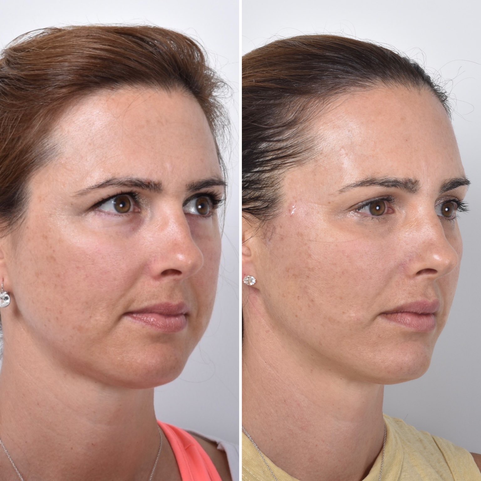 Brow and Eye Threadlift - Best Clinic Sydney for Dermal Fillers