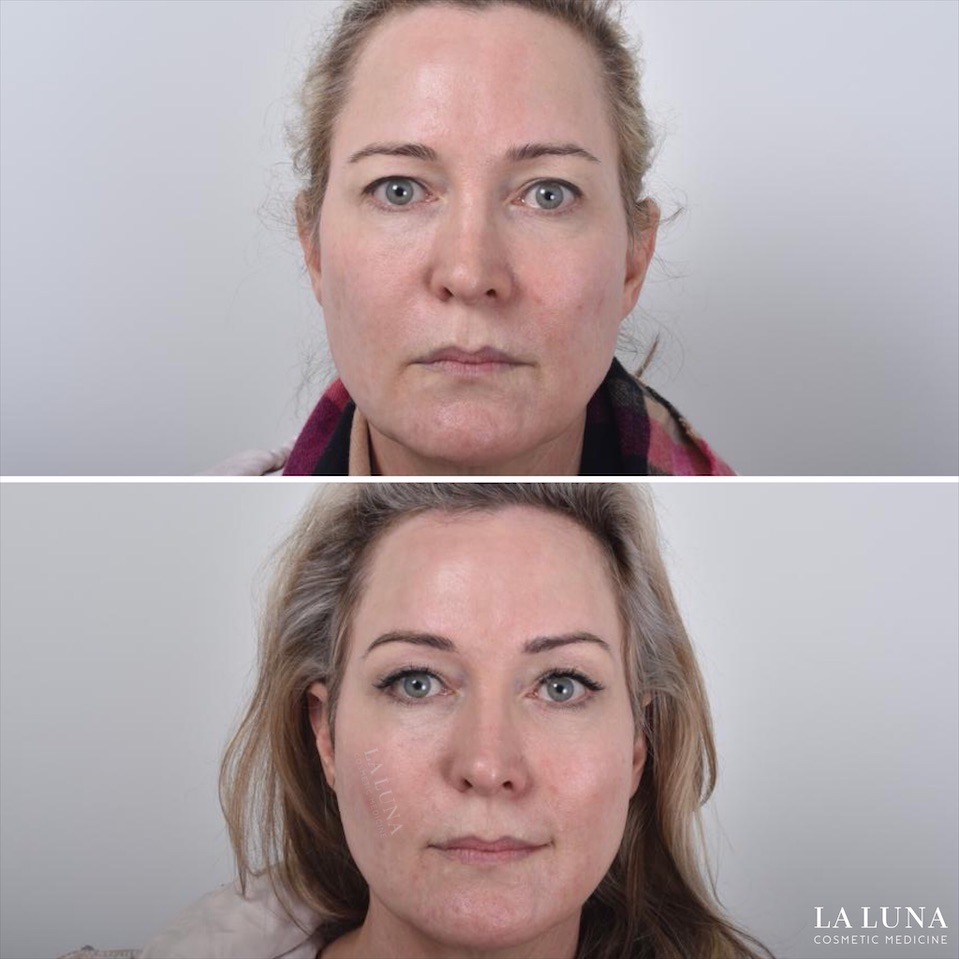 Before and after thread facelift sydney