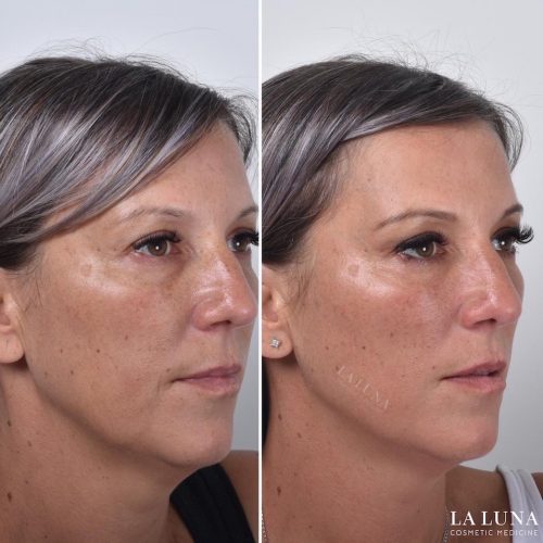 Thread Lift Sydney - #1 Cosmetic Doctors Face - Neck & Cheek Lift ...