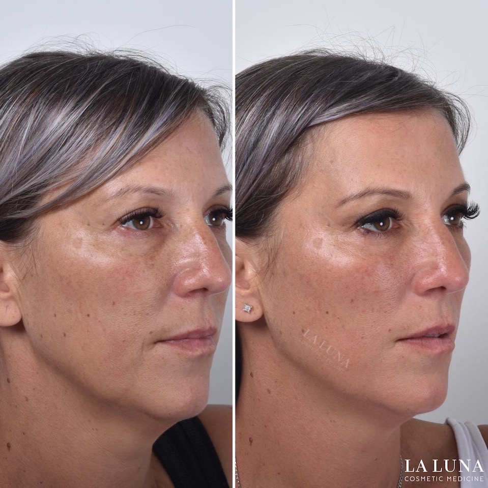 Face threadlift for cheeks