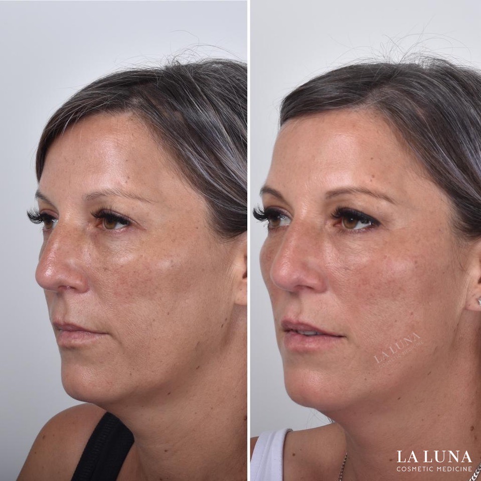 Best Thread Facelift Sydney