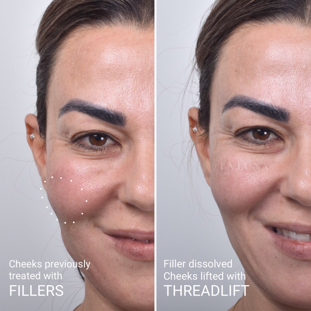 Brow and Eye Threadlift - Best Clinic Sydney for Dermal Fillers