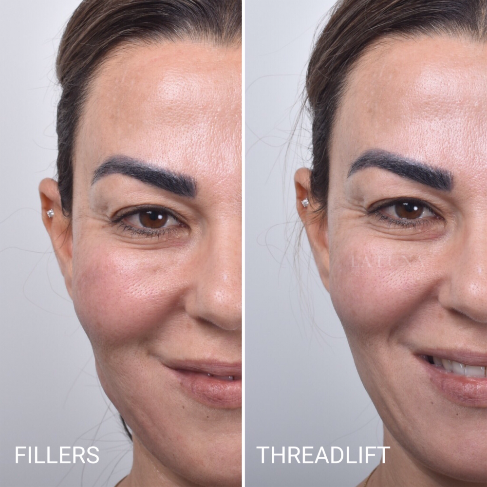 Thread Lift Sydney - #1 Cosmetic Doctors Face - Neck & Cheek Lift ...