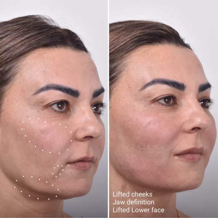 Thread Lift Sydney 1 Cosmetic Doctors Face Neck And Cheek Lift