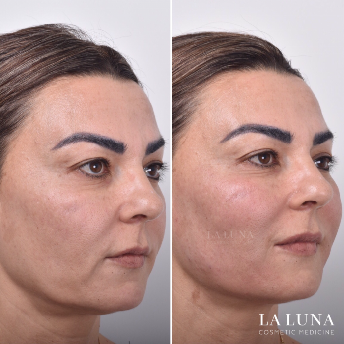 before and after non surgical facelift