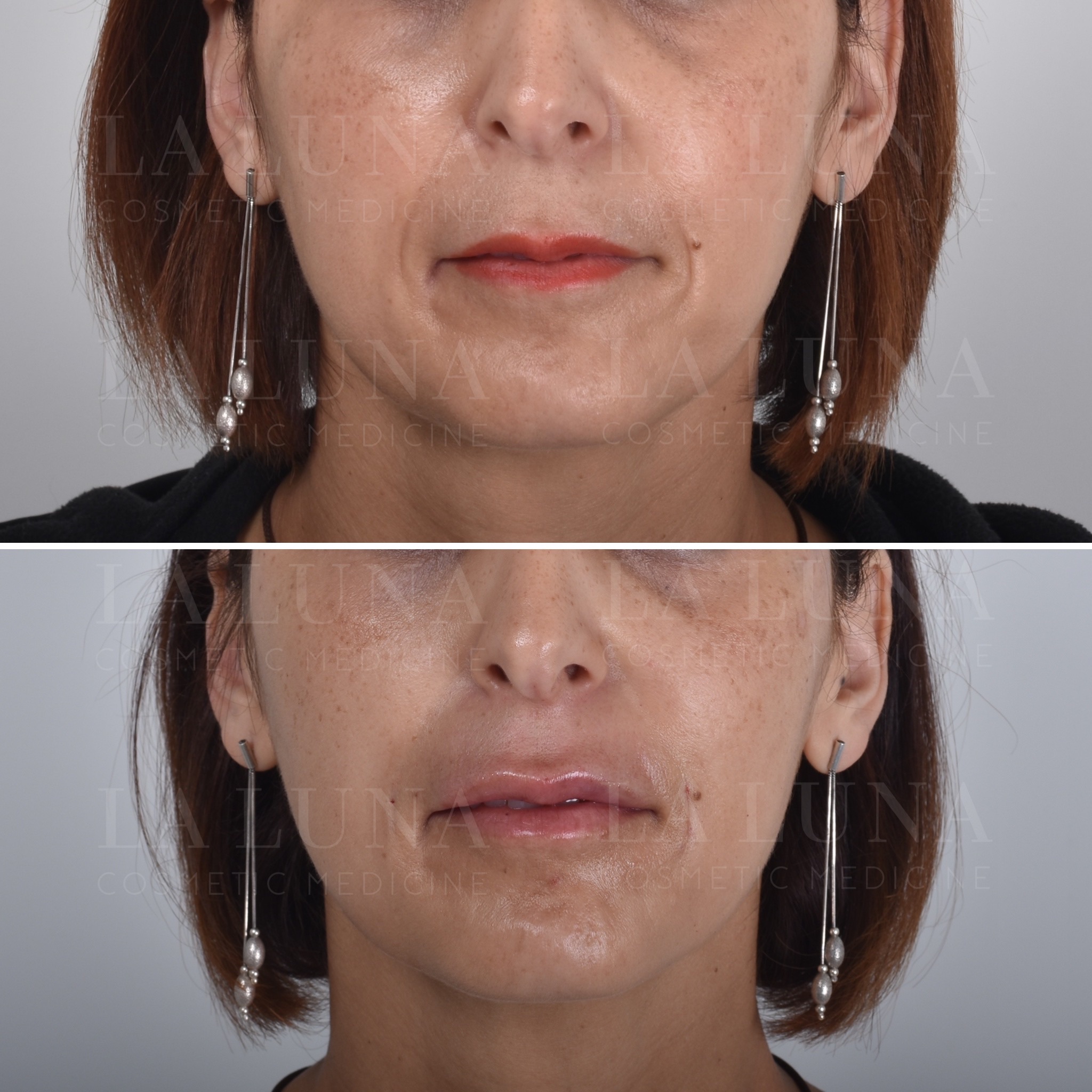 cheek thread lift sydney