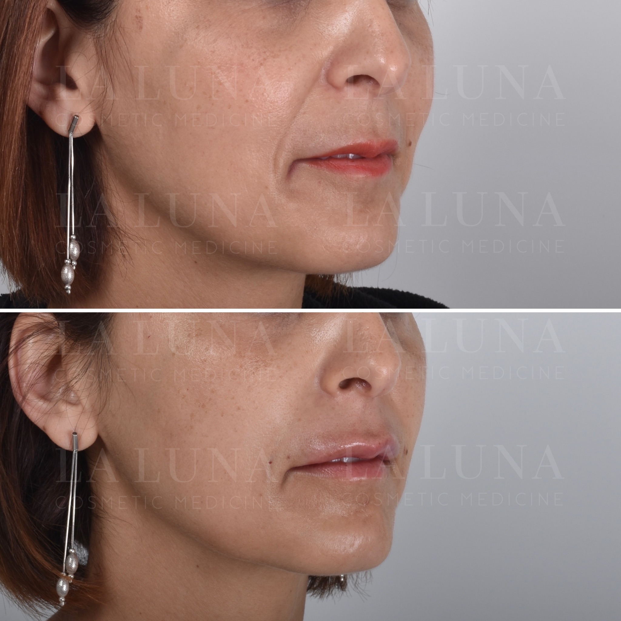 cheek thread lift sydney