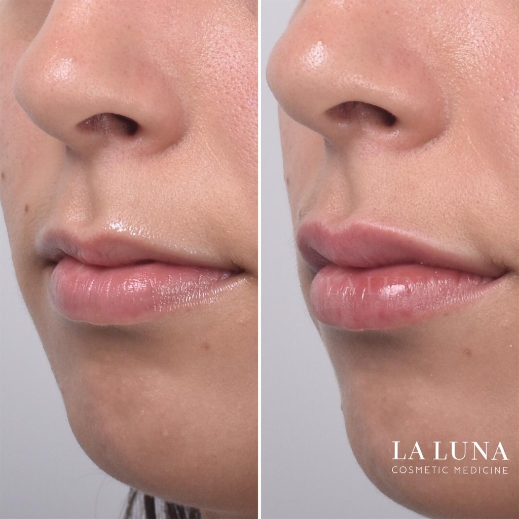 Before and after lip filler injections