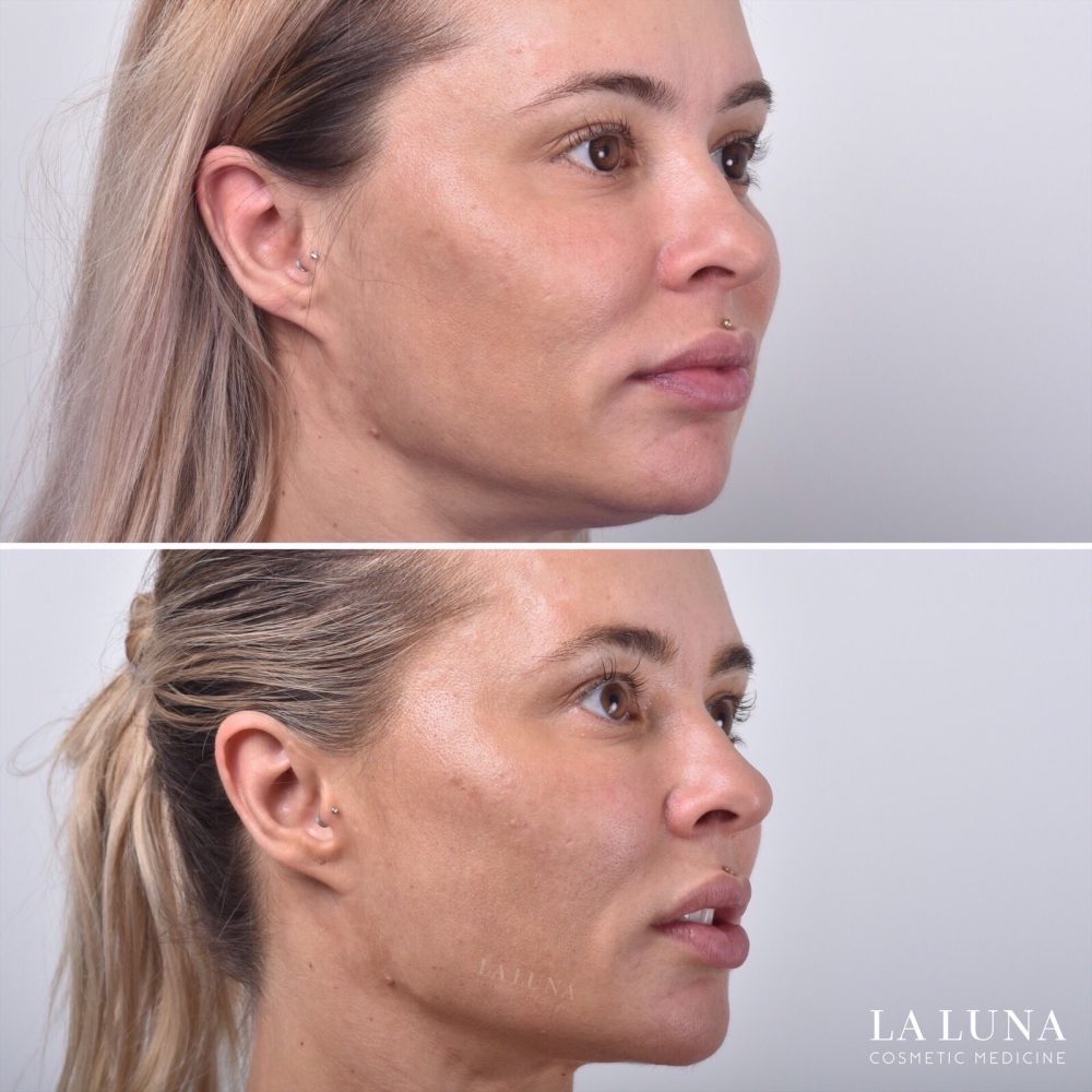 Jowl Lift Anyone ? How To " Easily " Lift Sagging Skin Without Surgery
